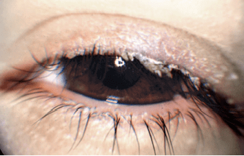 Bakterielle Lidrandentzündung mit Krusten auf den Wimpern