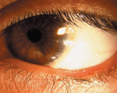Augenlidentzündung mit trockenen Augen und Krusten