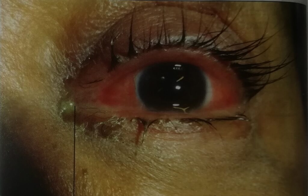 Pus discharge due to bacterial conjunctivitis