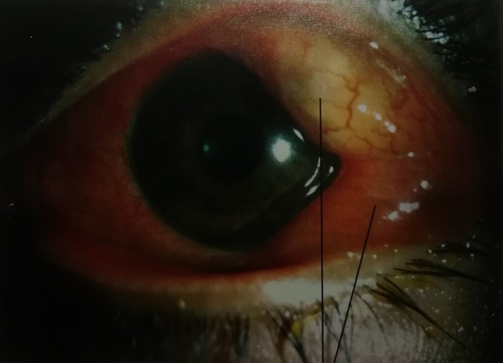 Chemosis or swelling of the conjunctiva due to acute inflammation (viral conjunctivitis)