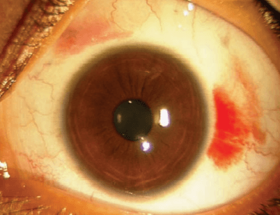 Blood under the conjunctiva due to inflammation