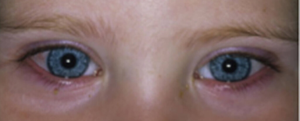 Allergische Bindehautentzündbei einem Kind