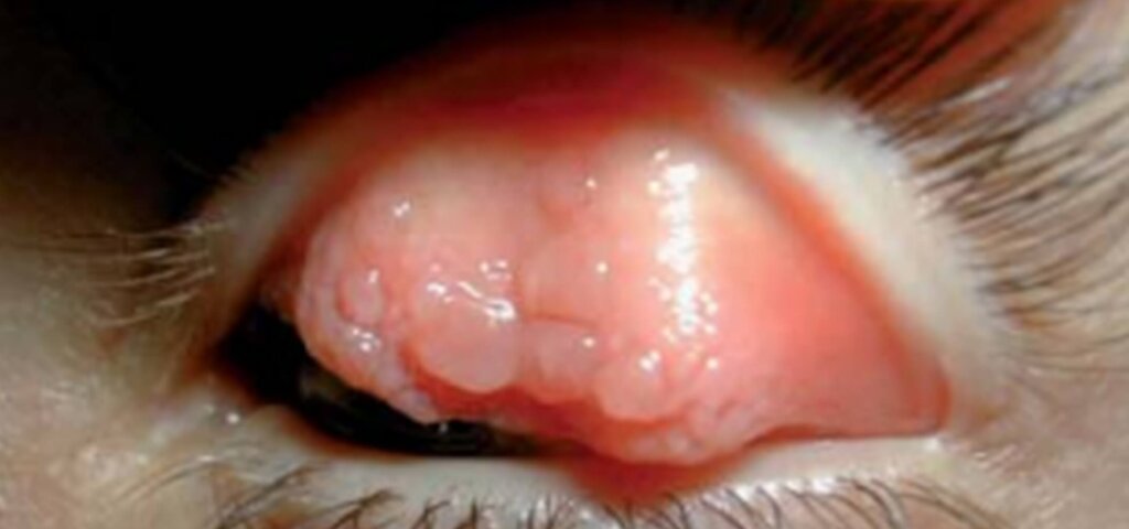Allergische Bindehautentzündung mit Riesenpapillen