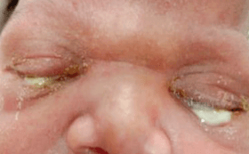 bindehautentzündung säugling Yellos Eiter über den Augenlidern