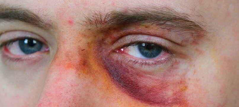 Bluterguss im Auge aufgrund einer Verletzung