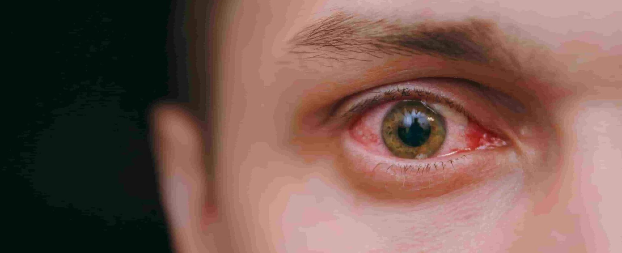 Blutunterlaufene Augen: Sollten Sie besorgt sein? » MedWisePlus