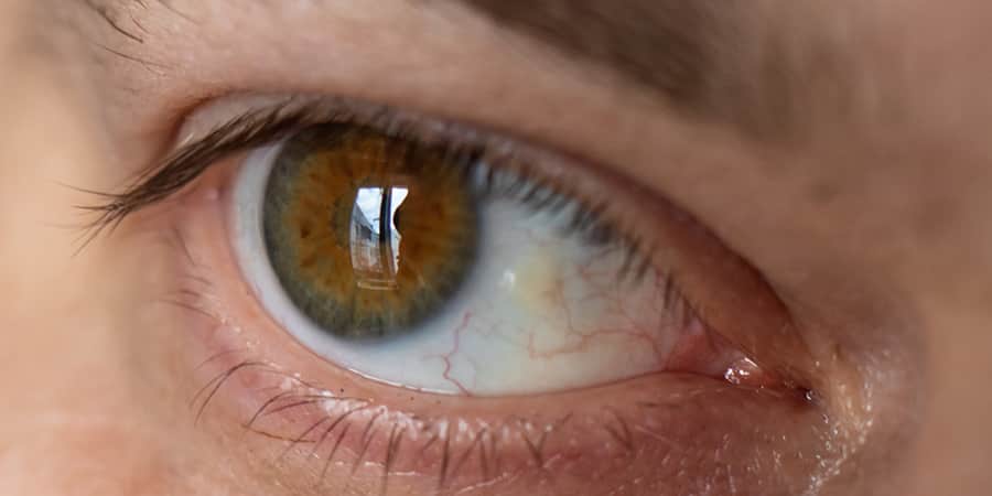 Fremdkörpergefühl im Auge: Pinguecula