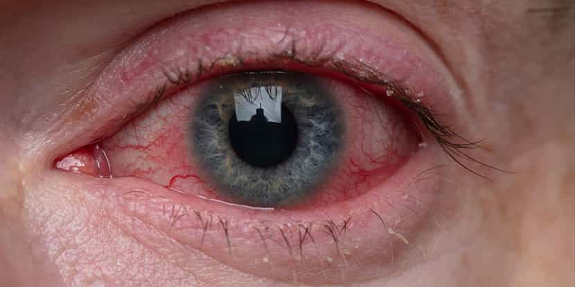Blutunterlaufene Augen aufgrund von Allergien