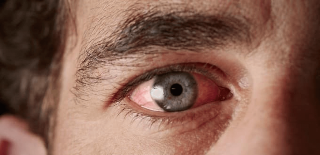 Sjögren-Syndrom und trockene Augen