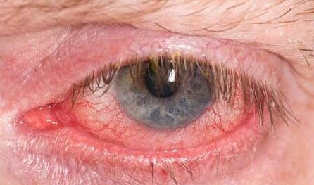 Augenlidentzündung und Trockenes Auge