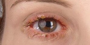 Ist Augenlidentzündung ansteckend?