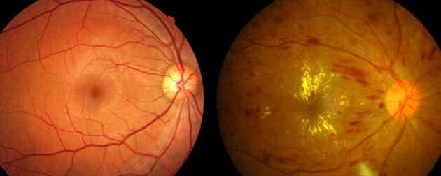 diabetische retinopathie stadien